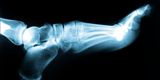 Bone Spurs vs. Arthritis: What’s the Difference?