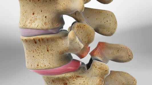 Spondylolysis and Spondylolisthesis