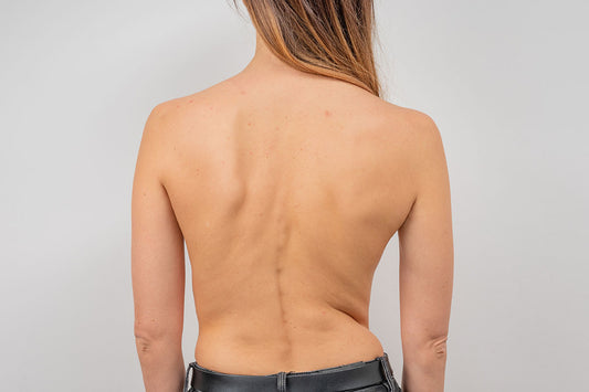 Understanding Scoliosis: Causes, Symptoms, and Treatment Options