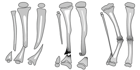 Congenital Pseudarthrosis of the Tibia