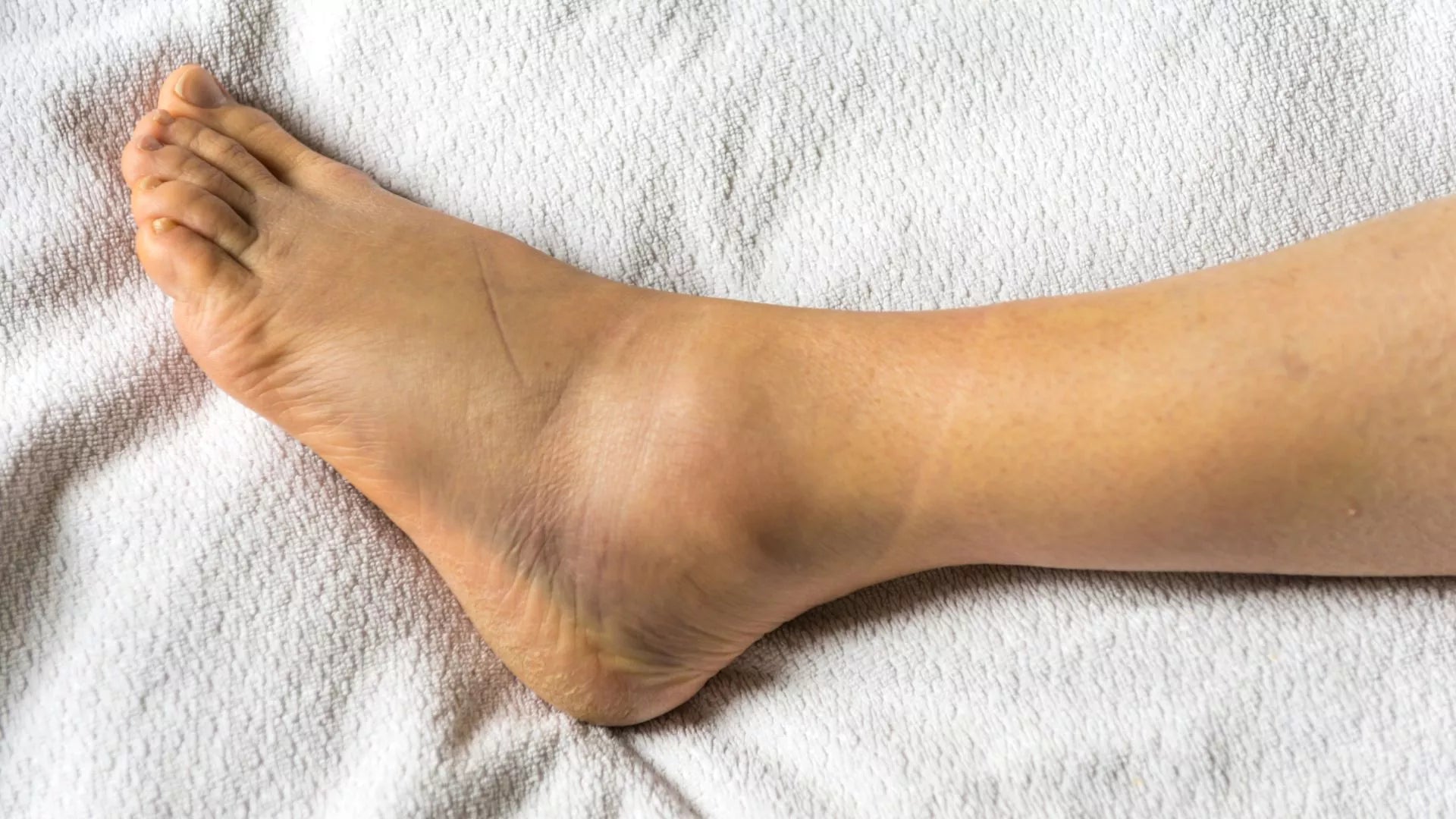 Sprains and Strains: Promoting Faster Healing for Ankle Injuries