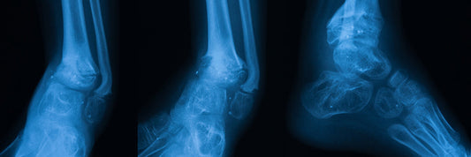 The Importance of Early Diagnosis in Ankle Bone Conditions