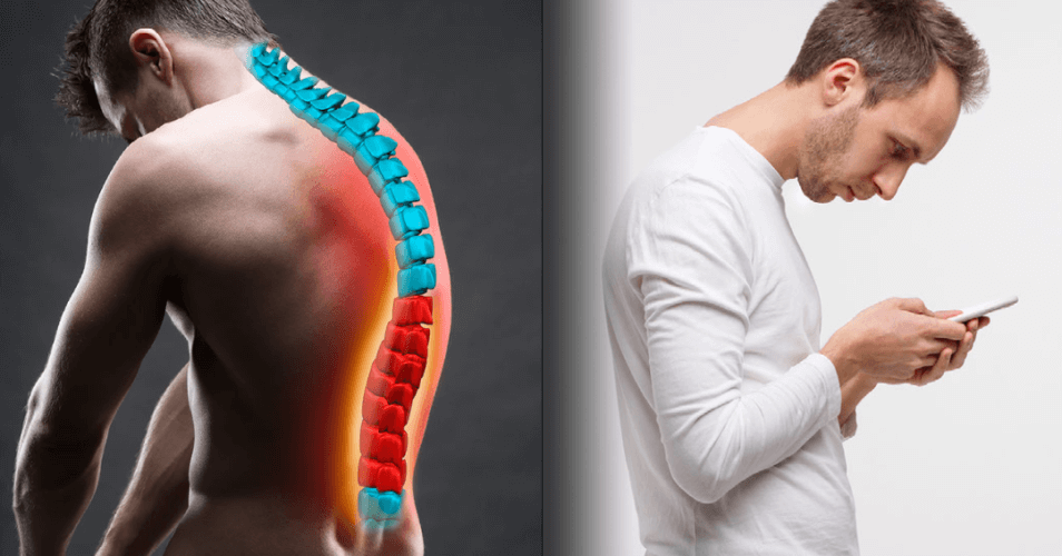 Understanding Kyphosis