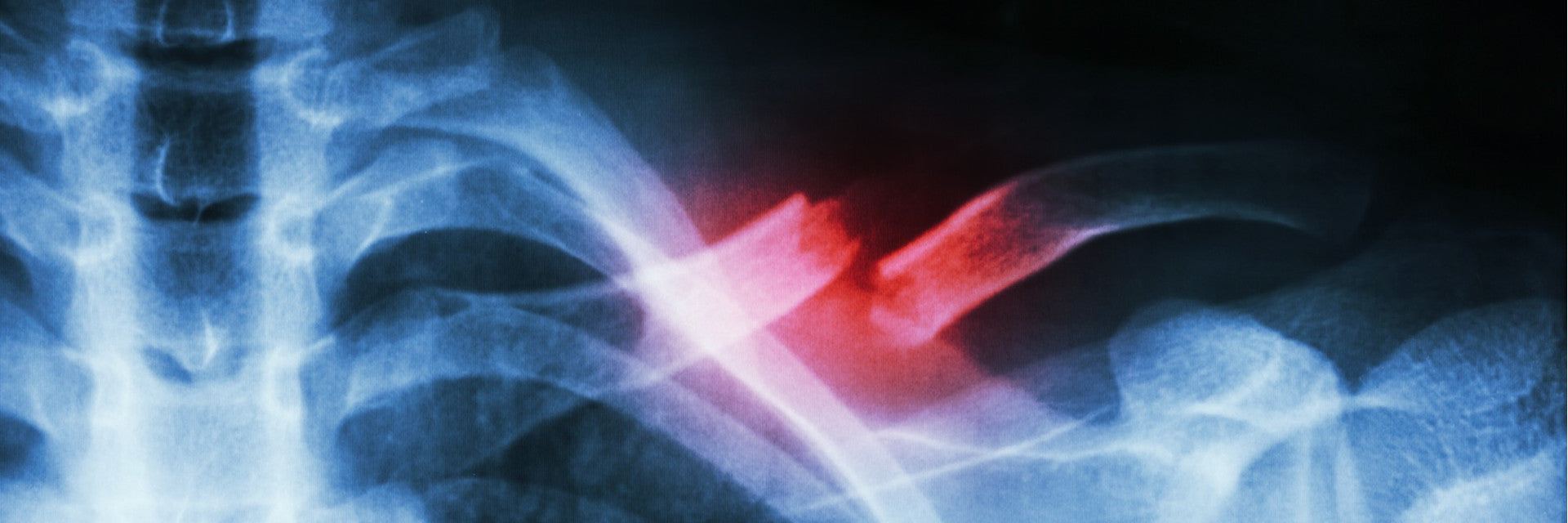 Fractured Collarbone