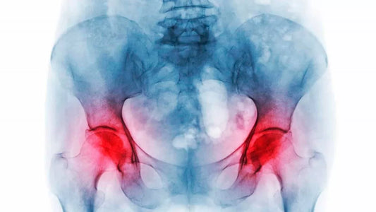 Femur Bone Condition: Osteonecrosis
