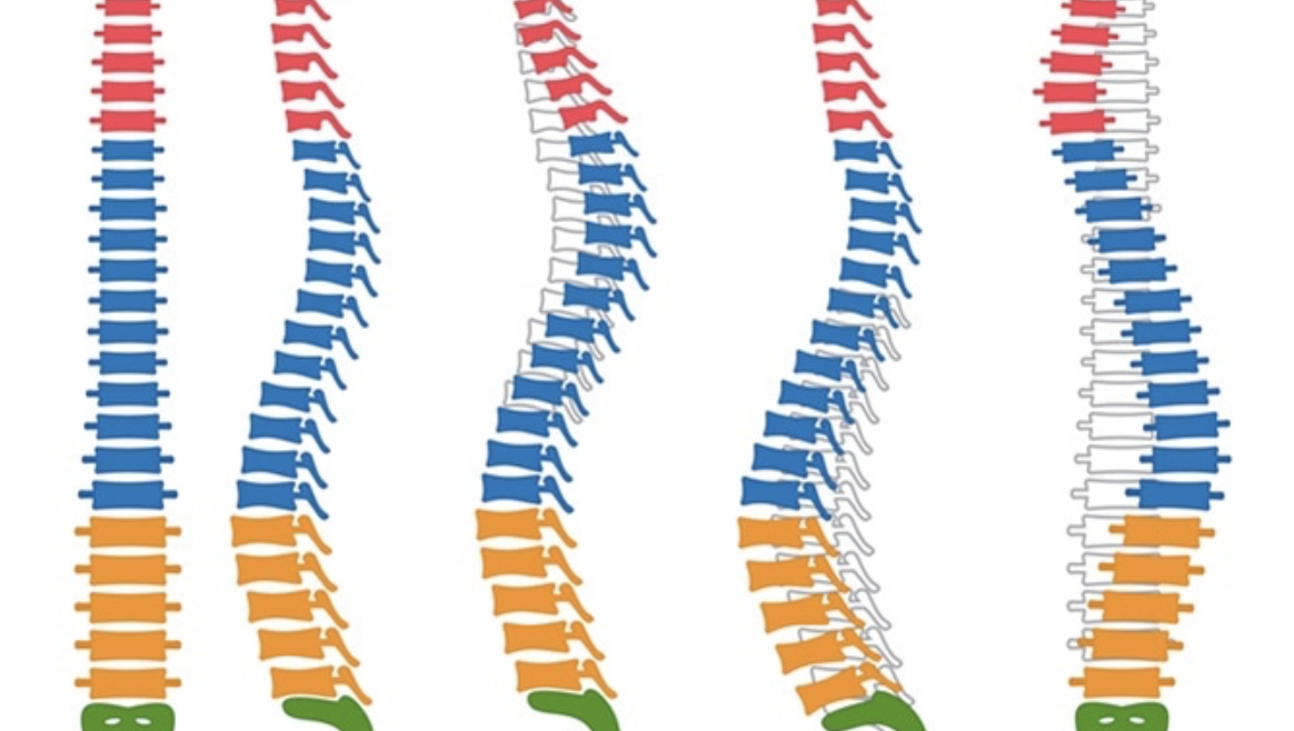 Spinal Deformity